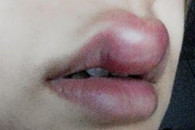 毒吻 美女被蚊子大哥亲了一口！